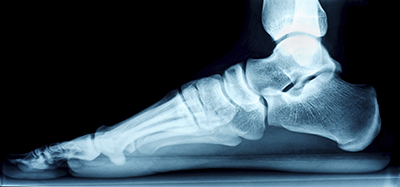 flat feet 2